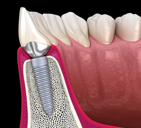Side-view of dental implant in jawbone