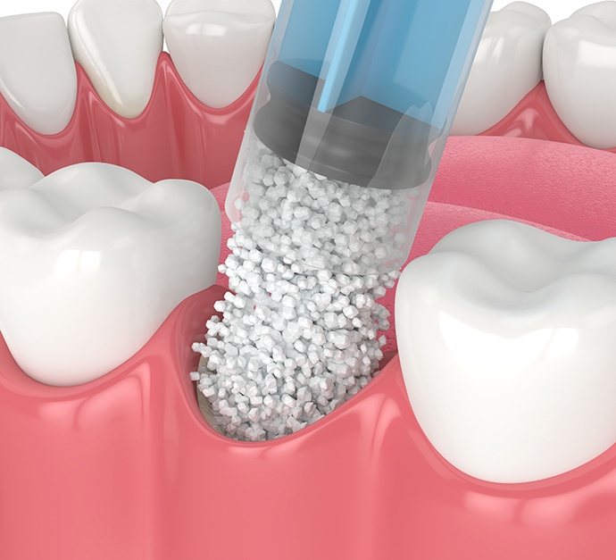 Illustration of granular bone material getting placed in tooth socket