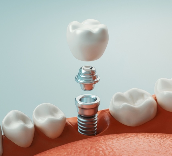 Illustrated dental implant being placed into the lower jaw