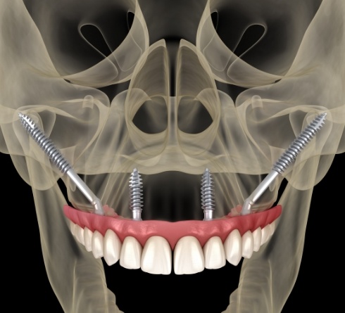 Illustrated x ray of skull with implant denture on upper arch
