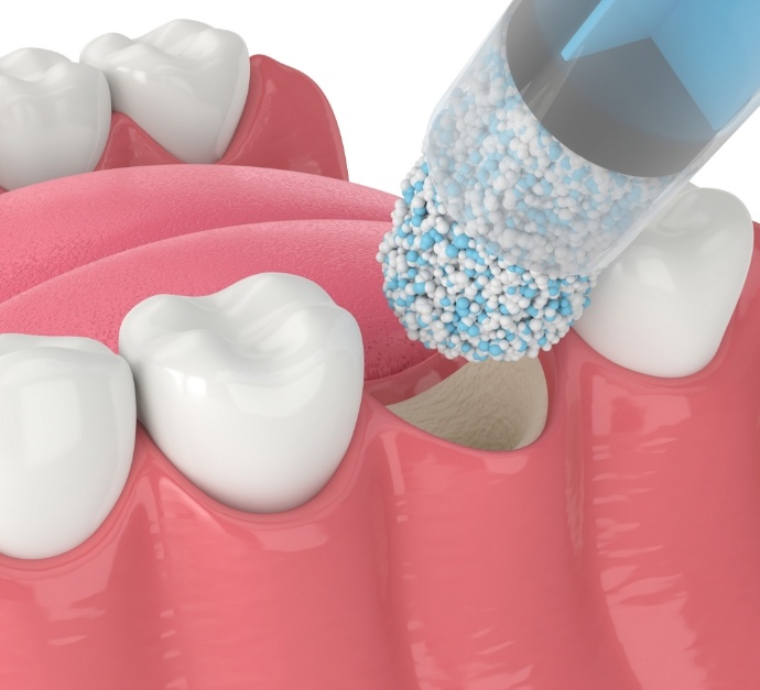 Illustrated bone grafting material being placed in jawbone where tooth is missing